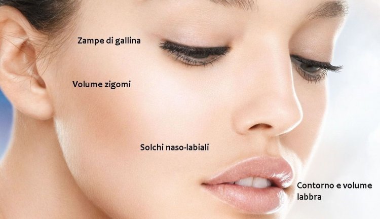 Medicina estetica - Filler con acido ialuronico - Ambulatorio Medical SPA